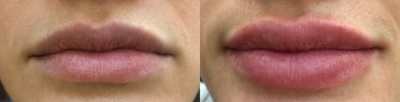 Dermal Fillers before and after photo