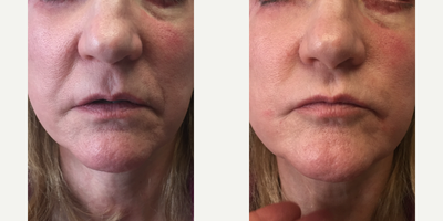 Juvederm before and after photo