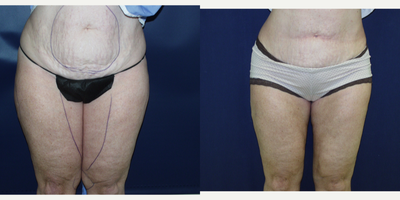 Liposuction before and after photo