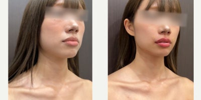 Radiesse before and after photo
