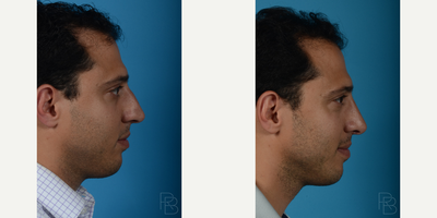 Rhinoplasty before and after photo