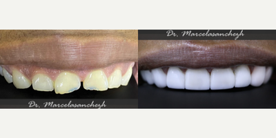 Smile Makeover before and after photo