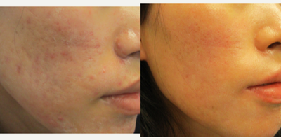 Accutane before and after photo