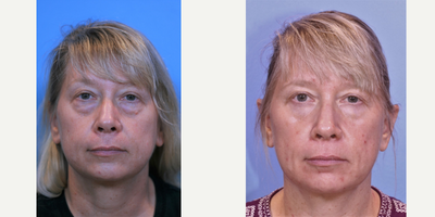 Eyelid Surgery before and after photo