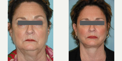 Facelift before and after photo