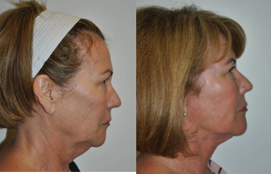 Neck Lift before and after photo