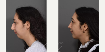 Rhinoplasty before and after photo