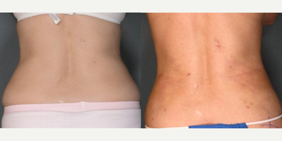 Vaser Liposuction before and after photo