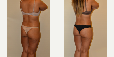 Butt Augmentation before and after photo