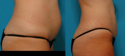 Smart Lipo before and after photo