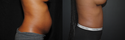 Tummy Tuck before and after photo