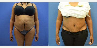 Tummy Tuck before and after photo