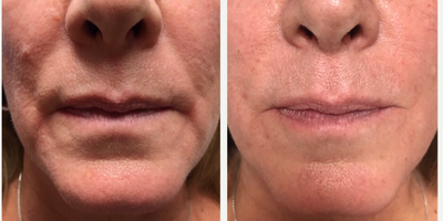 Dermal Fillers before and after photo