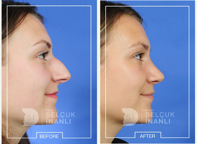 Rhinoplasty before and after photo