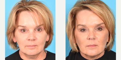 before and after image