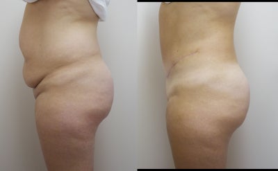 Tummy Tuck before and after photo