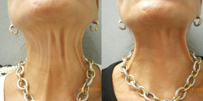 Botox before and after photo