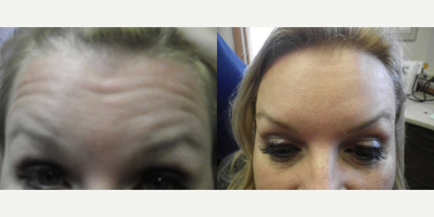 Botox before and after photo