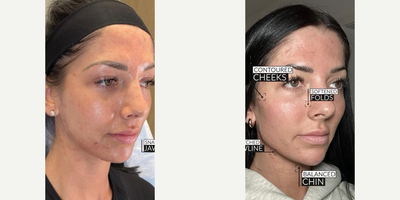 Dermal Fillers before and after photo