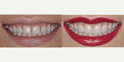 Porcelain Veneers before and after photo