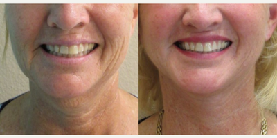 Bellafill before and after photo