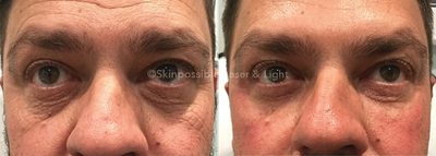 Dermal Fillers before and after photo
