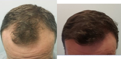 FUE Hair Transplant before and after photo