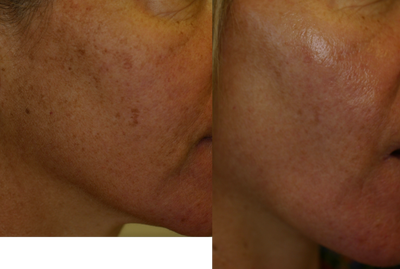 IPL before and after photo