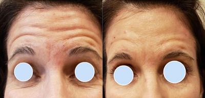 Juvederm before and after photo