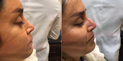 Nonsurgical Nose Job before and after photo
