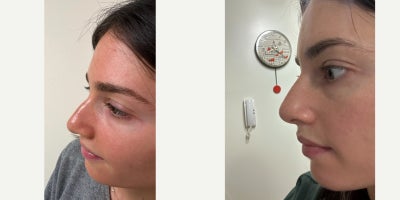 Nonsurgical Nose Job before and after photo