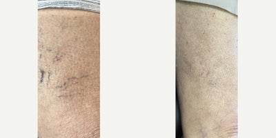 PicoSure before and after photo