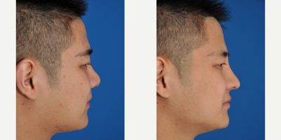 Asian Rhinoplasty before and after photo