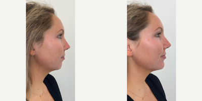 Chin Filler before and after photo