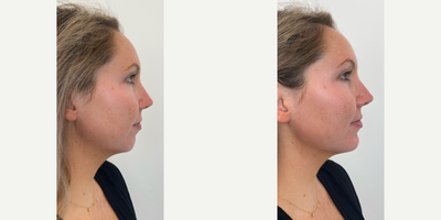 Chin Filler before and after photo