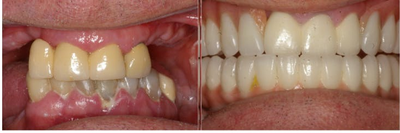 Dental Implants before and after photo