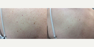 Excel V before and after photo