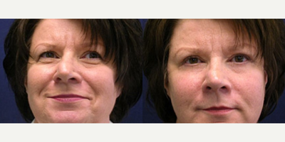 before and after image