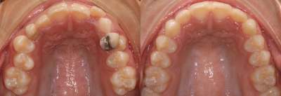 Clear Braces before and after photo