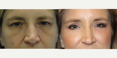 Eyelid Surgery before and after photo