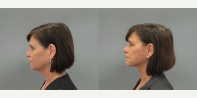 Eyelid Surgery before and after photo