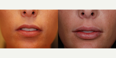 Juvederm before and after photo
