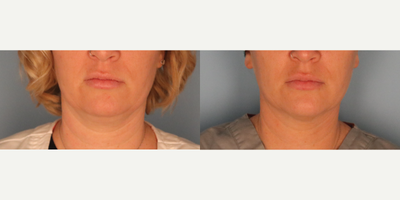 Kybella before and after photo