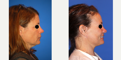 Brow Lift before and after photo