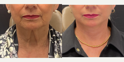 Facelift before and after photo