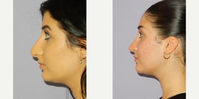 Rhinoplasty before and after photo