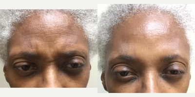 Botox before and after photo