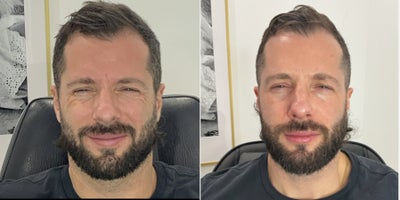 Botox before and after photo