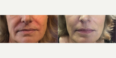 Dermal Fillers before and after photo