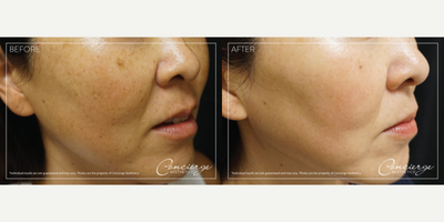 IPL before and after photo